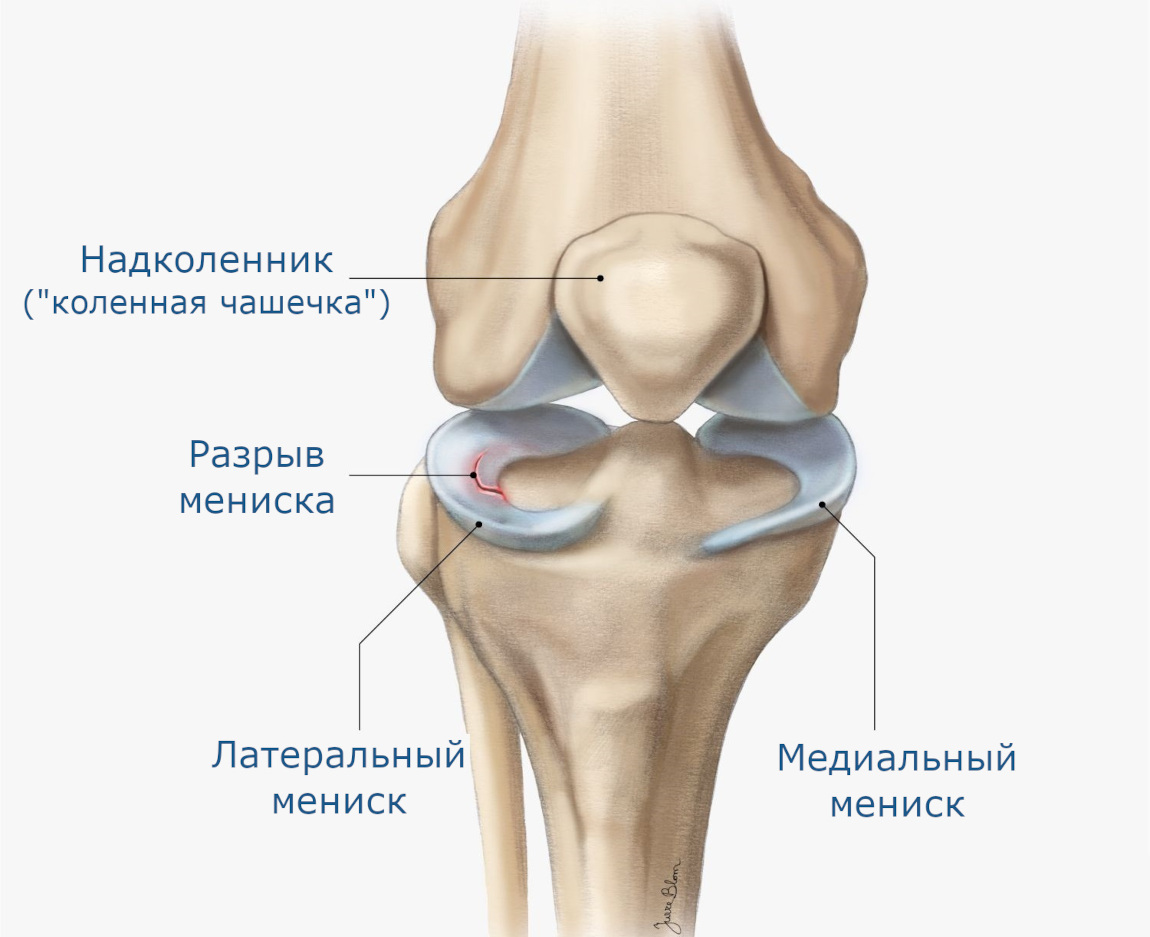 Анатомия коленного сустава - мениски и их разрыв