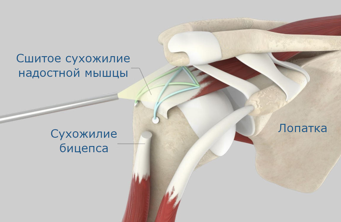 Схема результата лечения ротаторной манжеты плечевого сустава