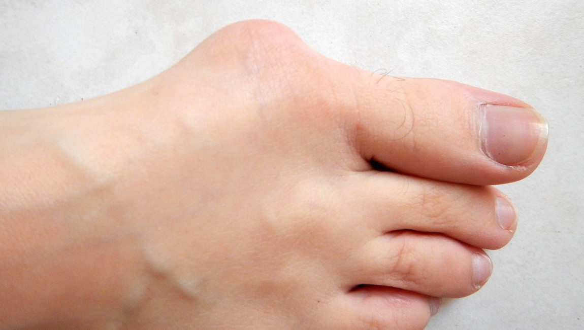 Показания к операции при вальгусной деформации большого пальца стопы