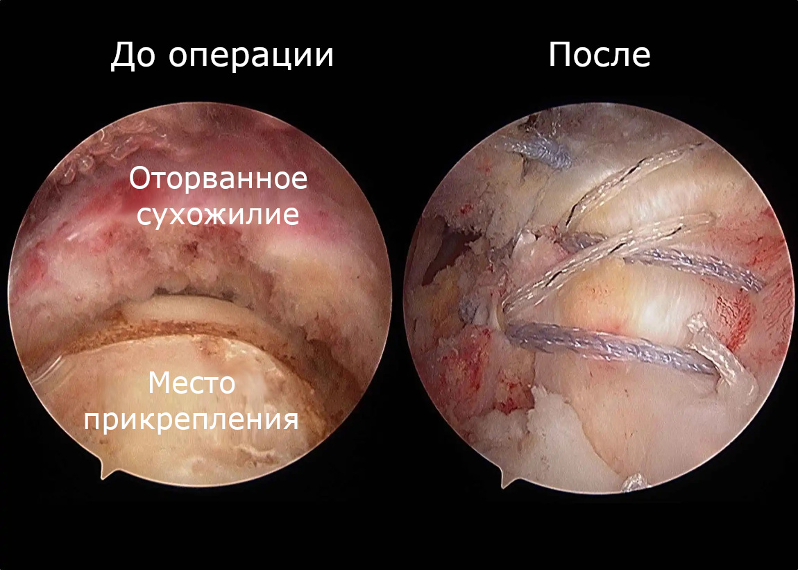 До и после лечения разрыва манжеты плеча (вид при артроскопии)