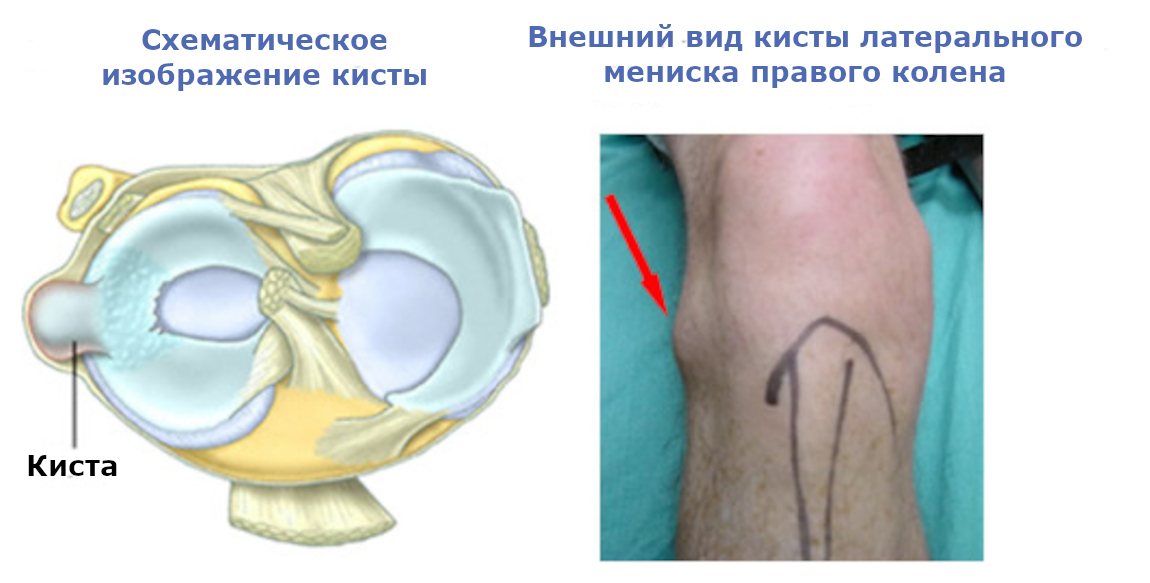 Поврежденный мениск колена. Киста медиального мениска. Разрыв мениска коленного.