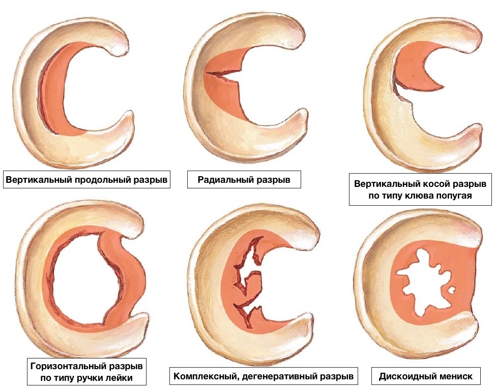 Типы повреждений мениска