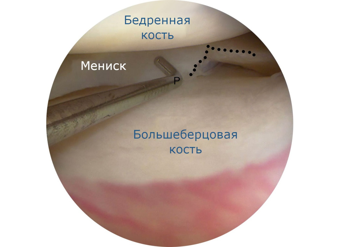 Артроскопия при разрыве мениска коленного сустава