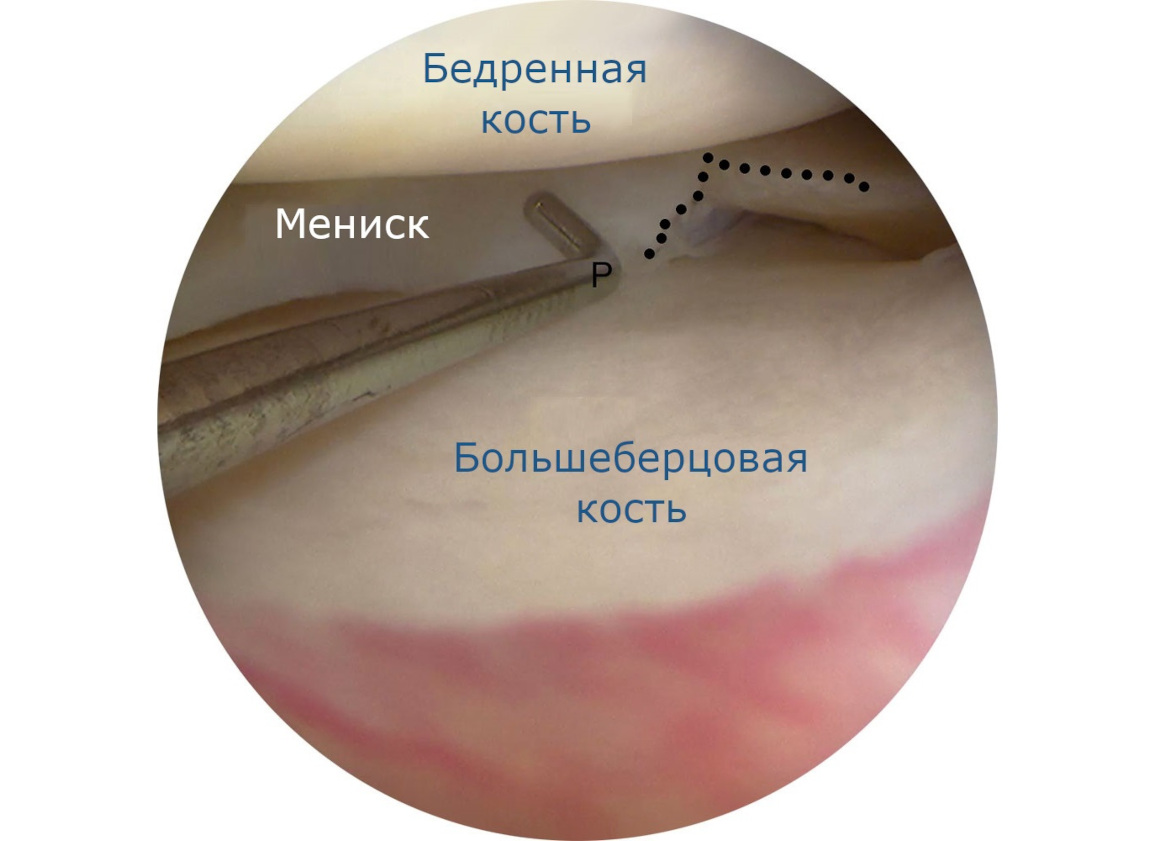 Малоинвазивная хирургия при повреждениях суставов