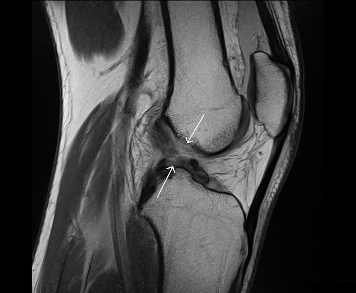 Синовит повреждения передней крестообразной связки. Снимок мрт колена разрыв мениска. Снимок мрт коленного сустава с разрывом мениска. Повреждение мениска коленного сустава рентген. Разрыв мениска коленного сустава на мрт.