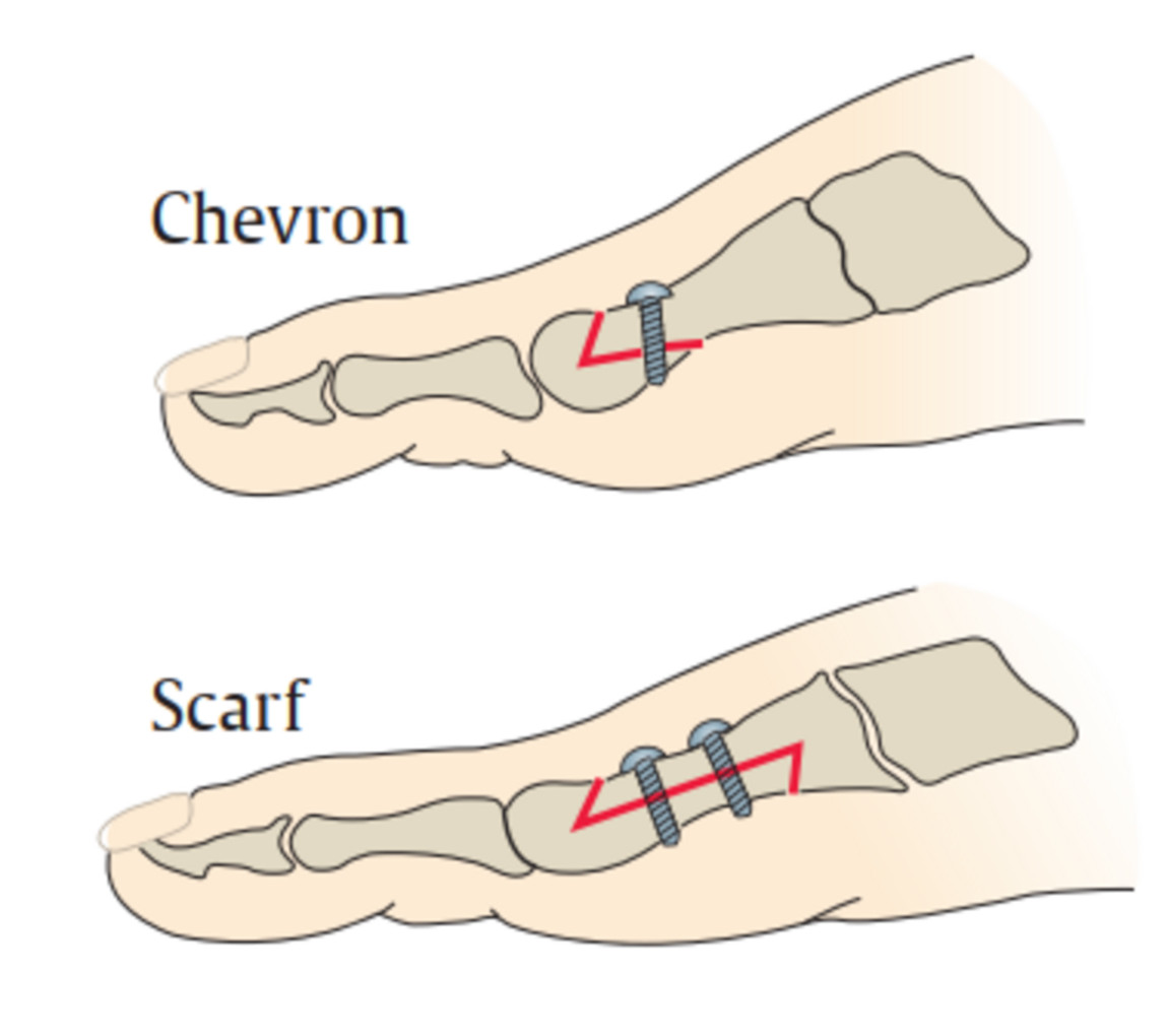 Схема операции остеотомии – Chevron и Scarf