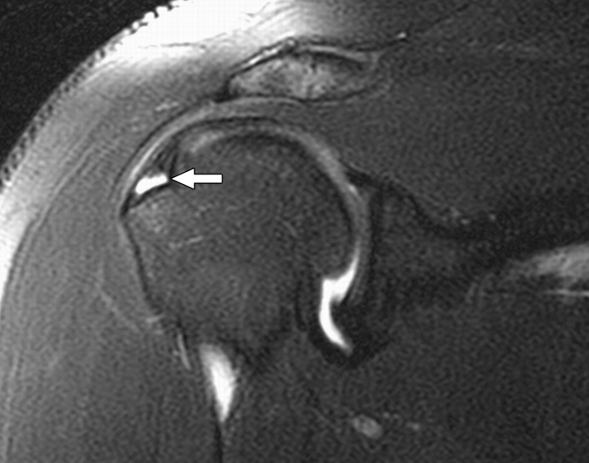МРТ снимок с разрывом сухожилия надостной мышцы 