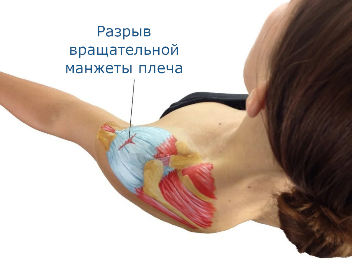 Разрыв вращательной манжеты плечевого сустава