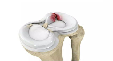  Разрыв мениска коленного сустава