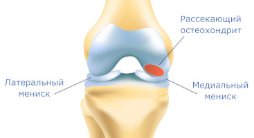 Рассекающий остеохондрит коленного сустава (болезнь Кёнига)