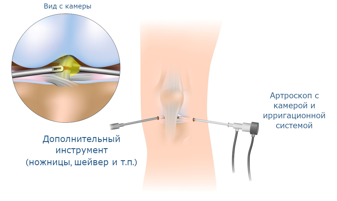 Артроскопия коленного сустава в Москве. Разумная цена, хорошие отзывы